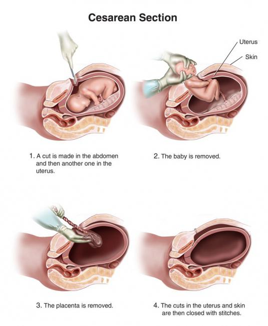 цезарово сечение предимства и минуси на анестезия