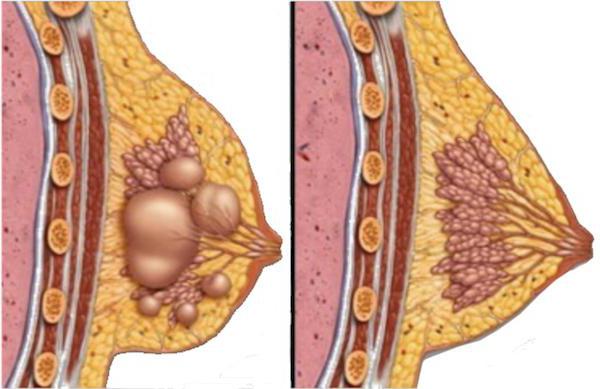 киста на гърдата
