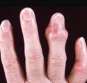 Основните симптоми на ревматоиден артрит