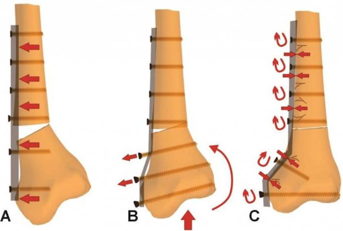 osteosynthesis какво е това?